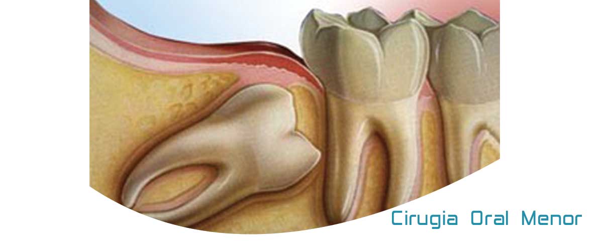 cirurgia-oral-menor