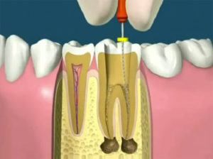 endodontia