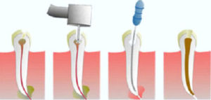 endodontia2