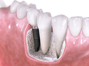 implantes2