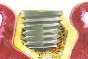 implantes4