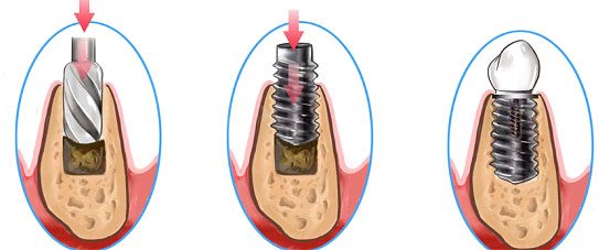 implantes5