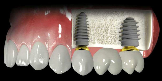 implantes6