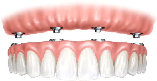 implantes8